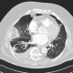 Lung infarction, development in time, initial examination: CT - Computed tomography